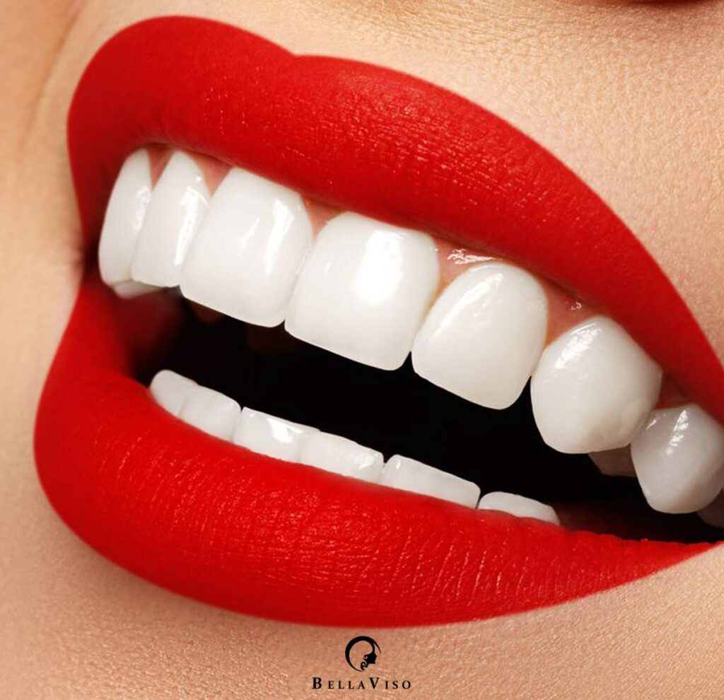Transform Your Smile with Dental Veneers in Dubai – Get the Perfect Teeth You’ve Always Wanted