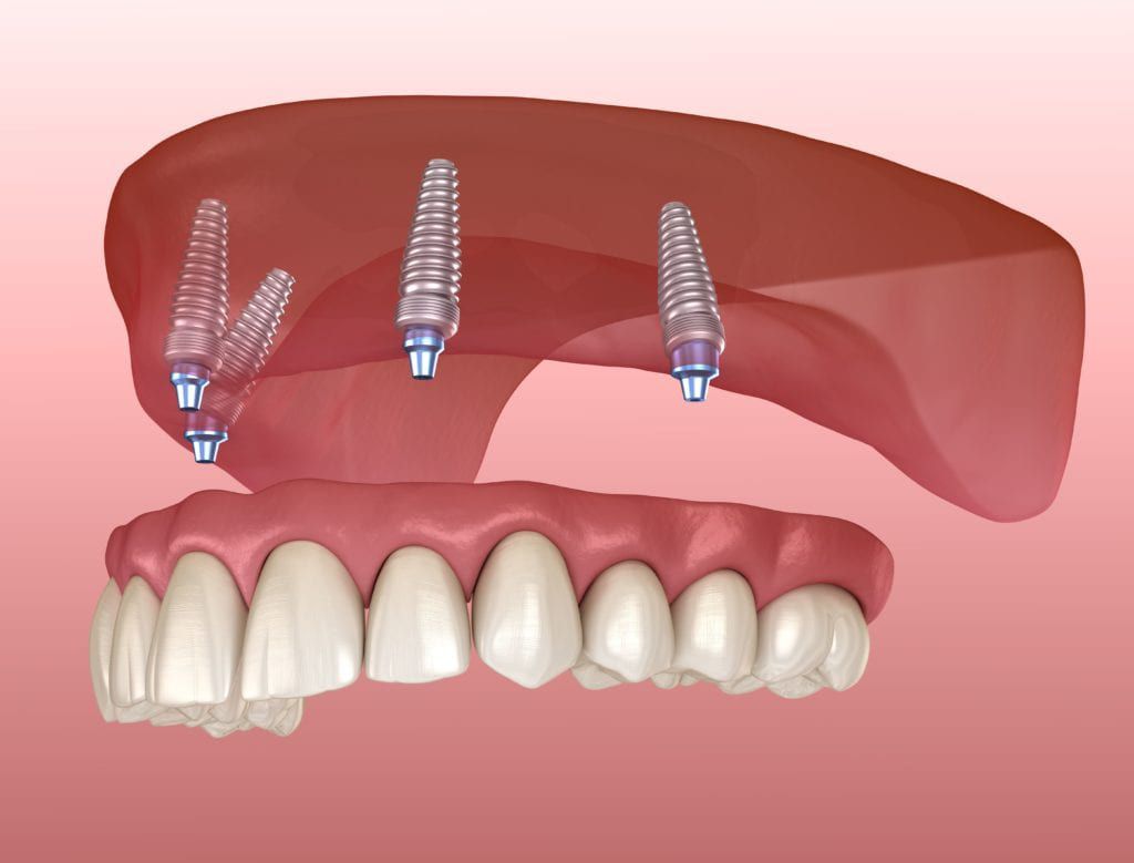 Advantages of Dentures and Implants for Replacing Missing Teeth